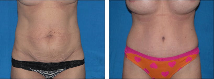 Tummy Tuck Gallery - Patient 74866393 - Image 1