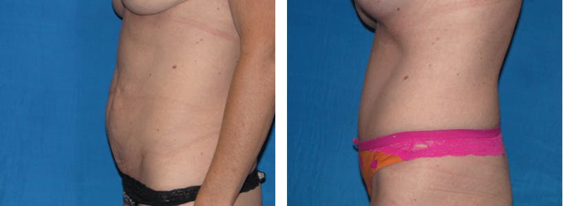 Tummy Tuck Before & After Gallery - Patient 74866393 - Image 2
