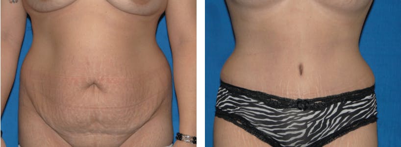 Tummy Tuck Before & After Gallery - Patient 74866394 - Image 1