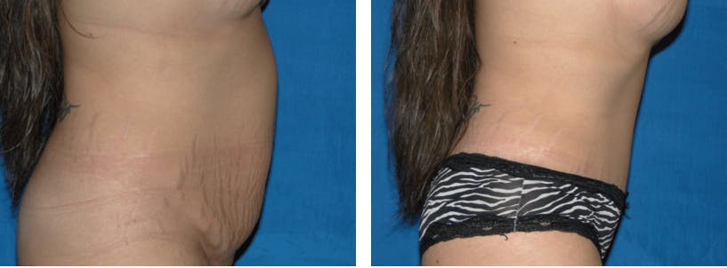 Tummy Tuck Before & After Gallery - Patient 74866394 - Image 2