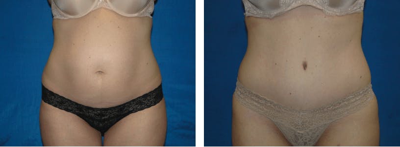 Tummy Tuck Before & After Gallery - Patient 74866395 - Image 1