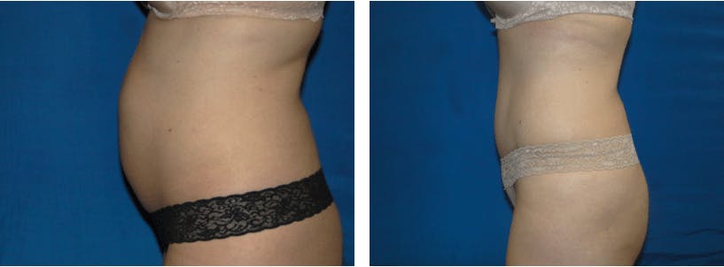 Tummy Tuck Before & After Gallery - Patient 74866395 - Image 2