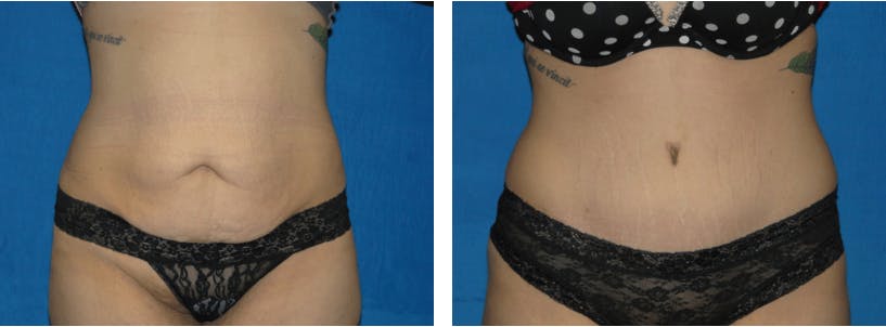Tummy Tuck Before & After Gallery - Patient 74866396 - Image 1