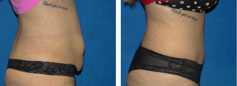 Tummy Tuck Before & After Gallery - Patient 74866396 - Image 2