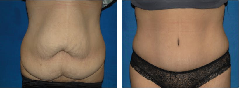 Tummy Tuck Gallery - Patient 74866398 - Image 1
