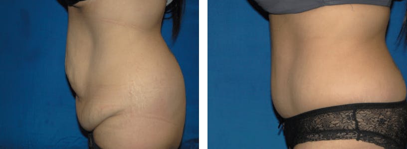 Tummy Tuck Before & After Gallery - Patient 74866398 - Image 2