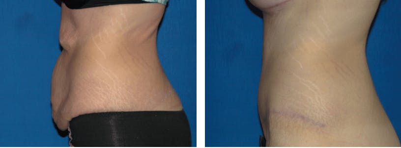 Tummy Tuck Before & After Gallery - Patient 74866399 - Image 1