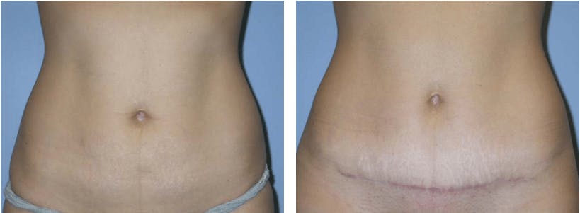 Tummy Tuck Before & After Gallery - Patient 74866400 - Image 1