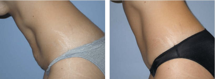Tummy Tuck Before & After Gallery - Patient 74866400 - Image 2