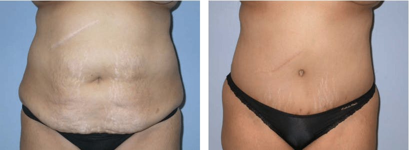 Tummy Tuck Gallery - Patient 74866403 - Image 1