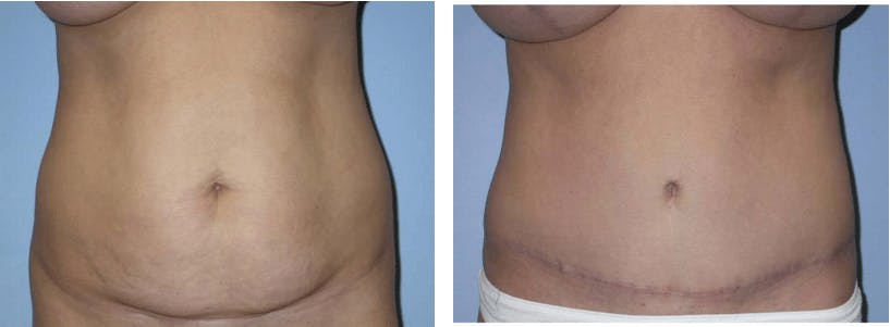 Tummy Tuck Before & After Gallery - Patient 74866410 - Image 1