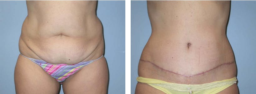 Tummy Tuck Before & After Gallery - Patient 74866412 - Image 1