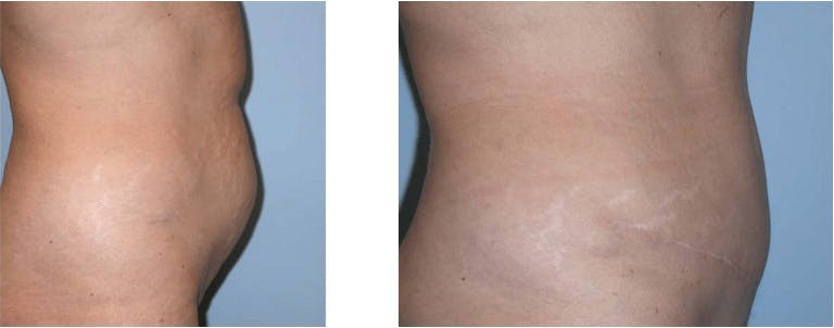 Tummy Tuck Gallery - Patient 74866417 - Image 1