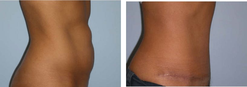 Tummy Tuck Before & After Gallery - Patient 74866418 - Image 1