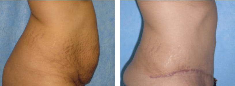 Tummy Tuck Gallery - Patient 74866419 - Image 1