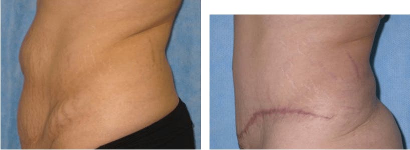 Tummy Tuck Before & After Gallery - Patient 74866424 - Image 2