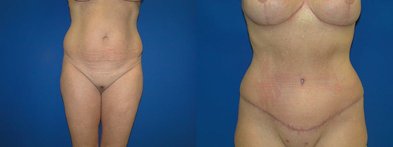 Tummy Tuck Before & After Gallery - Patient 74866425 - Image 1