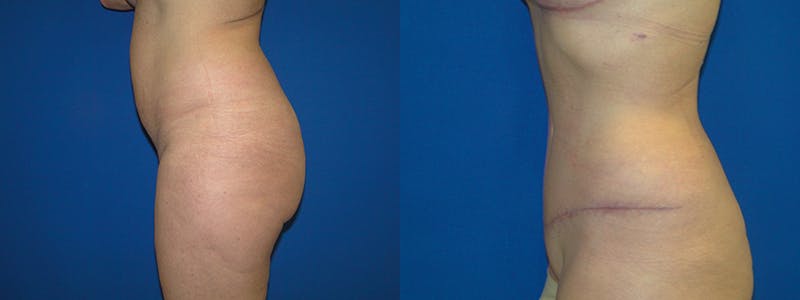 Tummy Tuck Before & After Gallery - Patient 74866425 - Image 2