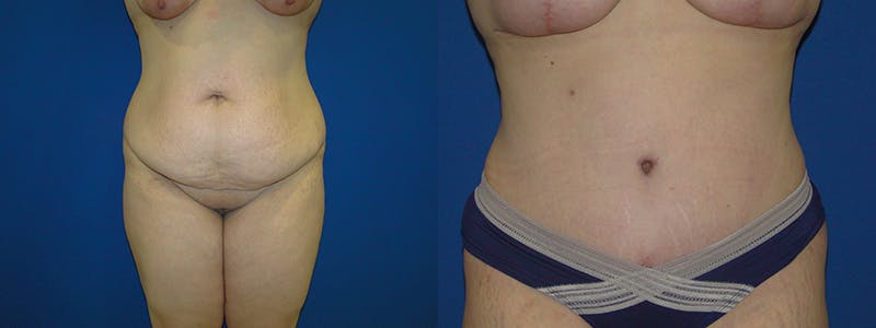Tummy Tuck Before & After Gallery - Patient 74866426 - Image 1