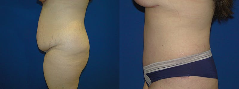 Tummy Tuck Before & After Gallery - Patient 74866426 - Image 2