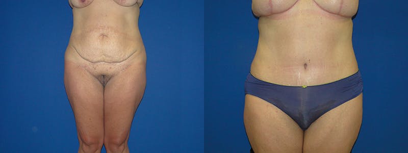 Tummy Tuck Before & After Gallery - Patient 74866427 - Image 1