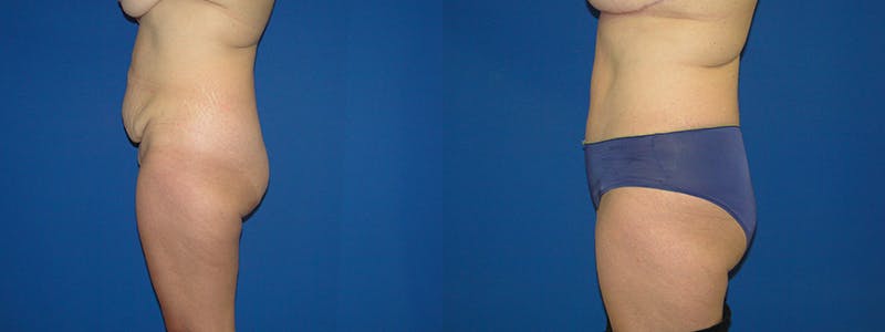 Tummy Tuck Before & After Gallery - Patient 74866427 - Image 2