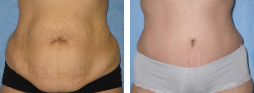 Tummy Tuck Before & After Gallery - Patient 74866424 - Image 1