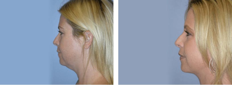 Liposuction Before & After Gallery - Patient 74866437 - Image 1
