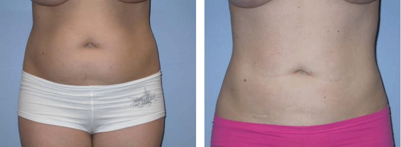 Liposuction Before & After Gallery - Patient 74866438 - Image 1