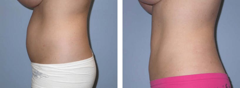 Liposuction Before & After Gallery - Patient 74866438 - Image 2