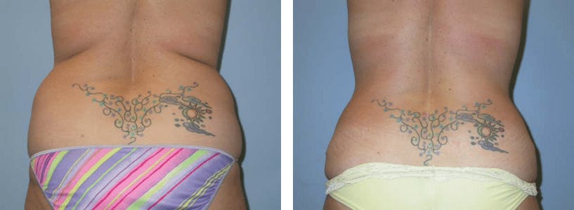 Liposuction Before & After Gallery - Patient 74866440 - Image 1