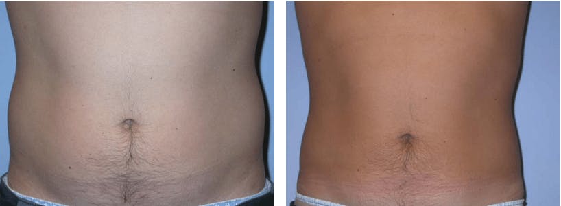 Liposuction Before & After Gallery - Patient 74866441 - Image 1