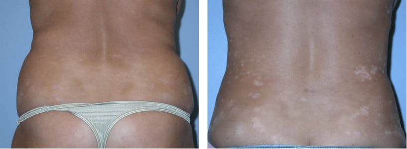 Liposuction Before & After Gallery - Patient 74866443 - Image 1