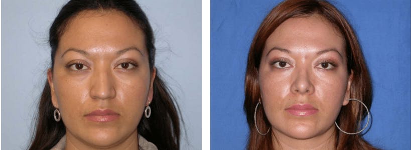 Liposuction Before & After Gallery - Patient 74866444 - Image 1