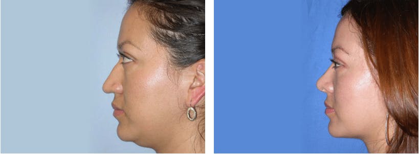 Liposuction Before & After Gallery - Patient 74866444 - Image 2