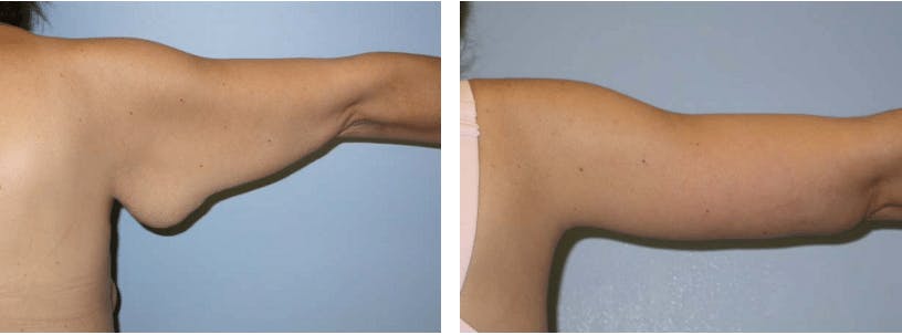 Arm Lift Before & After Gallery - Patient 74866552 - Image 1