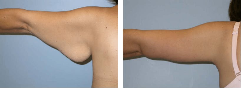 Arm Lift Before & After Gallery - Patient 74866552 - Image 2