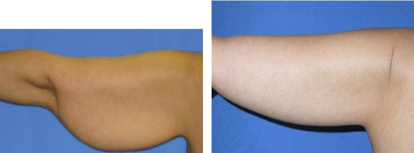 Arm Lift Before & After Gallery - Patient 74866562 - Image 2