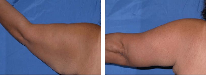 Arm Lift Before & After Gallery - Patient 74866576 - Image 1