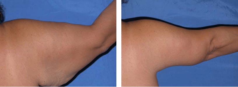 Arm Lift Before & After Gallery - Patient 74866576 - Image 2