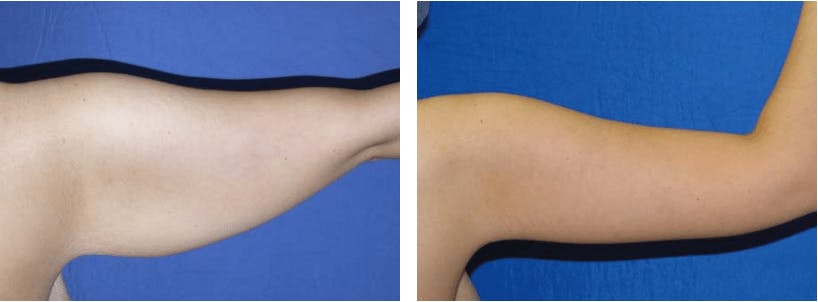 Arm Lift Before & After Gallery - Patient 74866586 - Image 1