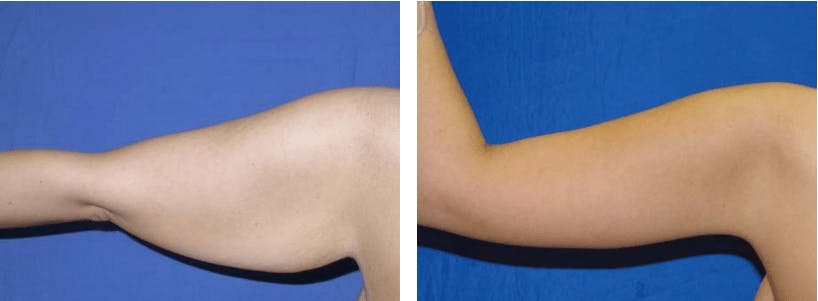 Arm Lift Before & After Gallery - Patient 74866586 - Image 2