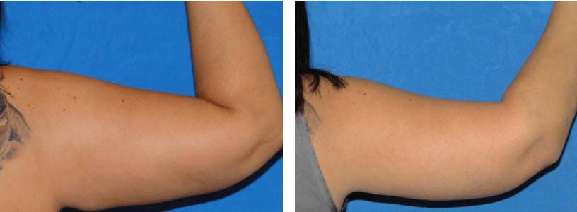 Arm Lift Before & After Gallery - Patient 74866596 - Image 1