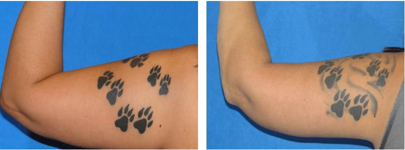 Arm Lift Before & After Gallery - Patient 74866596 - Image 2