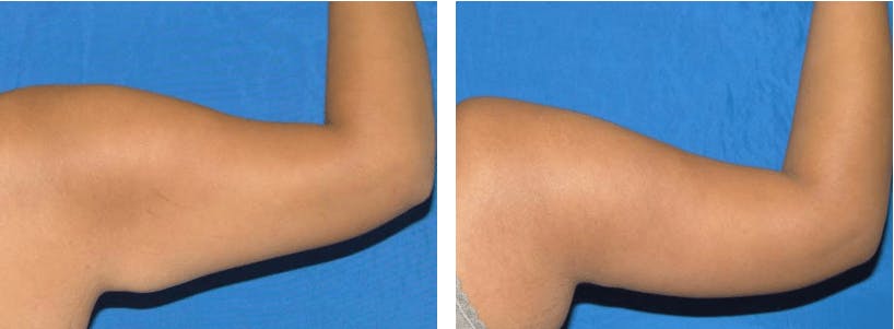 Before  & After Arm Lift in Orange County