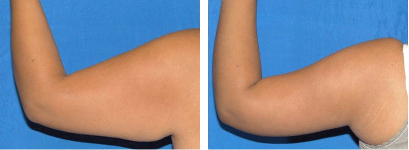 Arm Lift Before & After Gallery - Patient 74866604 - Image 2