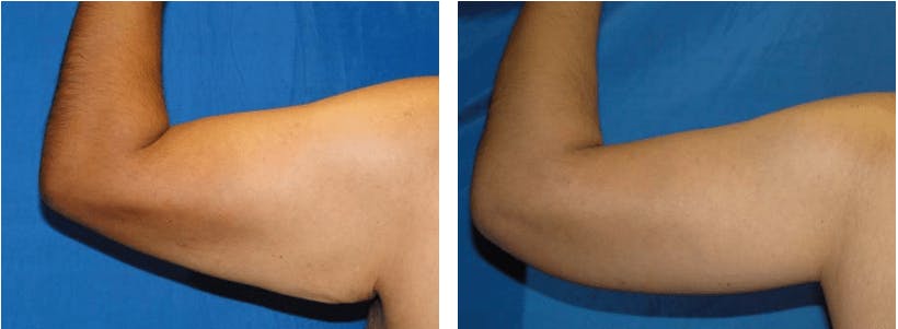 Arm Lift Before & After Gallery - Patient 74866612 - Image 1
