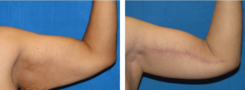 Arm Lift Before & After Gallery - Patient 74866612 - Image 2