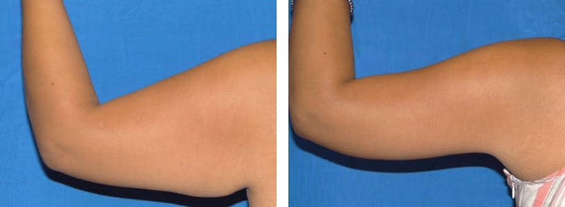 Arm Lift Before & After Gallery - Patient 74866622 - Image 1