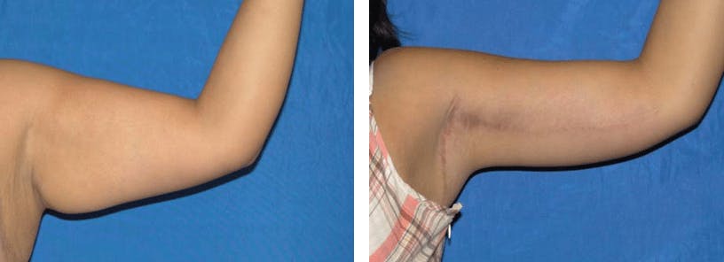 Arm Lift Before & After Gallery - Patient 74866622 - Image 2